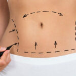 ابدومینوپلاستی یا جراحی زیبایی شکم در اهواز