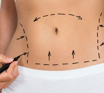 ابدومینوپلاستی یا جراحی زیبایی شکم در اهواز