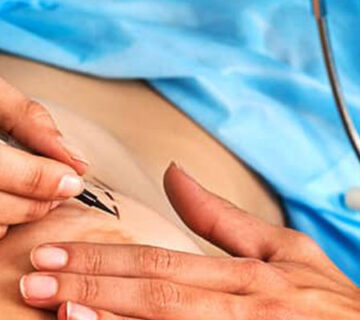 پروتز سینه چیست؟