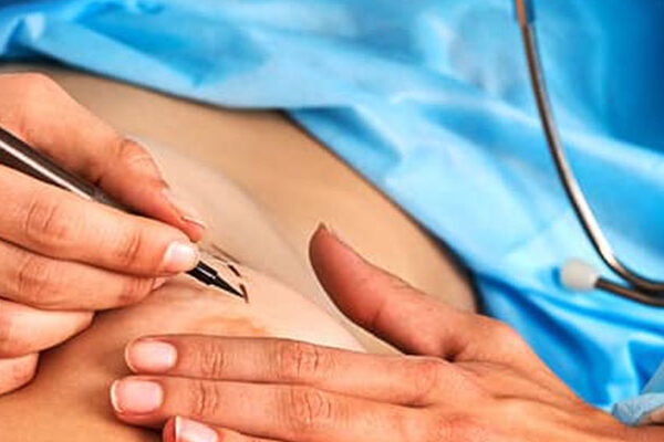 پروتز سینه چیست؟ پروتز سینه چیست؟