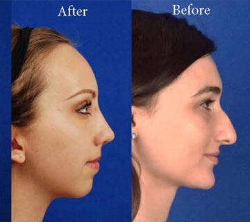 جراحی بینی در اهواز | جراح پلاستیک بینی در اهواز