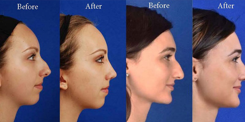 جراحی بینی در اهواز | جراح پلاستیک بینی در اهواز