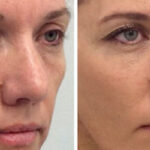 تزریق چربی در صورت