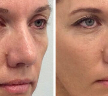 تزریق چربی در صورت