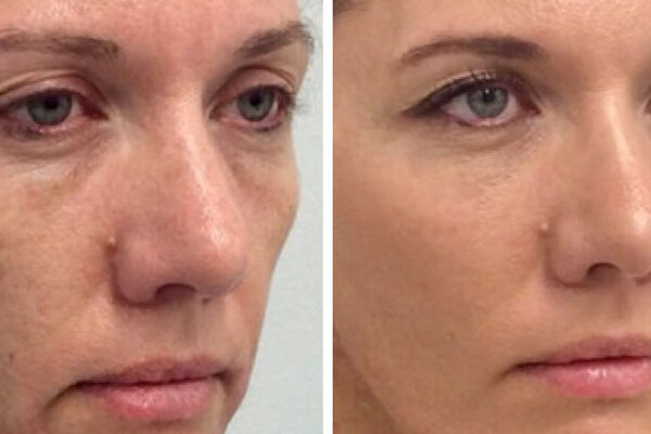 تزریق چربی در صورت تزریق چربی در صورت