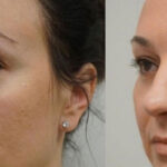 جراحی زیبایی پلک یا بلفاروپلاستی در اهواز