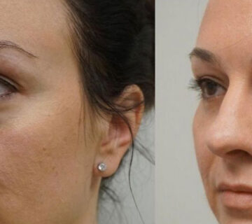 جراحی زیبایی پلک یا بلفاروپلاستی در اهواز