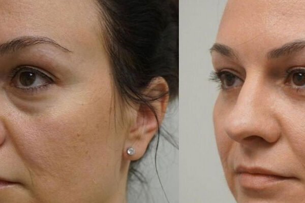 جراحی زیبایی پلک یا بلفاروپلاستی در اهواز جراحی زیبایی پلک یا بلفاروپلاستی در اهواز