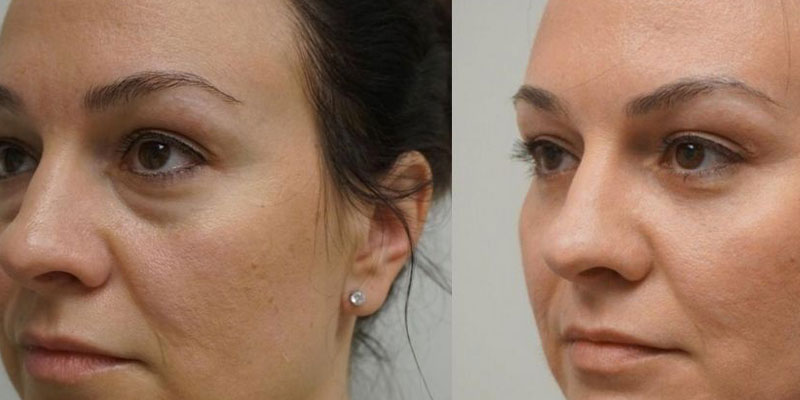 جراحی زیبایی پلک یا بلفاروپلاستی در اهواز