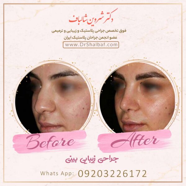 جراحی بینی در اهواز جراحی بینی در اهواز