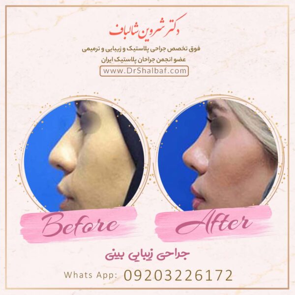 جراحی بینی در اهواز جراحی بینی در اهواز